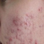 Tipuri de dermatită alergică, dermatită