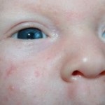 Tipuri de dermatită alergică, dermatită