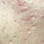 Tipuri de dermatită alergică, dermatită