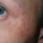 Tipuri de dermatită alergică, dermatită