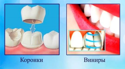 Furnir pe preturile si tipurile de dinti, instalarea furnirului pe dintele din fata Moscovei