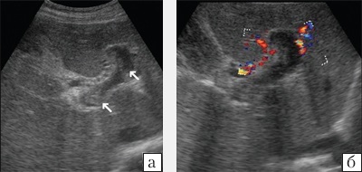 Az ultrahangvizsgálat lehetőségei színes Doppler térképezéssel a diagnózisban