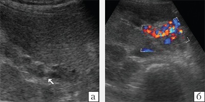 Az ultrahangvizsgálat lehetőségei színes Doppler térképezéssel a diagnózisban