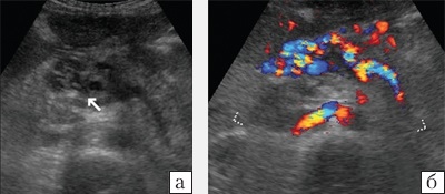 Az a lehetőség, ultrahang színes Doppler diagnosztikájában