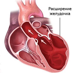 Toate articolele din secțiune - cardiomiopatii