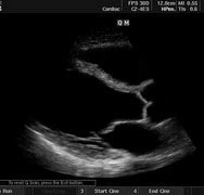 Toate articolele din secțiune - cardiomiopatii