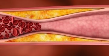 A koleszterin és atheroscleroticus plakkok az erekben, a szív és kezelésük