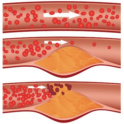 Colesterolul și plăcile aterosclerotice în vasele inimii și tratamentul acestora