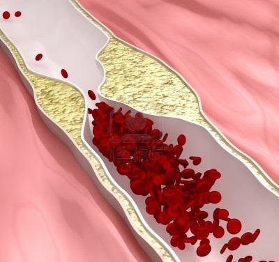 Colesterolul și plăcile aterosclerotice în vasele inimii și tratamentul acestora