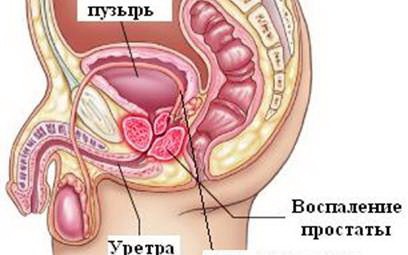 Prostatita cronică, tratamentul prostatitei