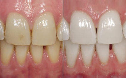 De ce este folositoare și dăunătoare fluorizarea dinților, foto