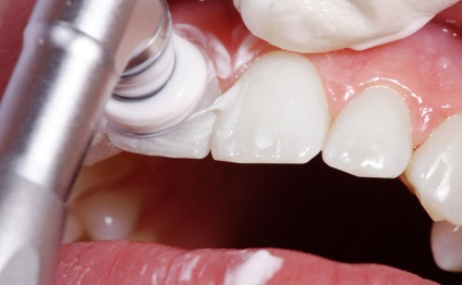 Miért van szükség a fogak fluoridálás előnyei és hátrányai, fotók