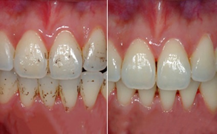 De ce este folositoare și dăunătoare fluorizarea dinților, foto