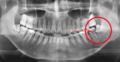 Dinții umani, așa cum au fost aranjați, clasificați, dentați mici