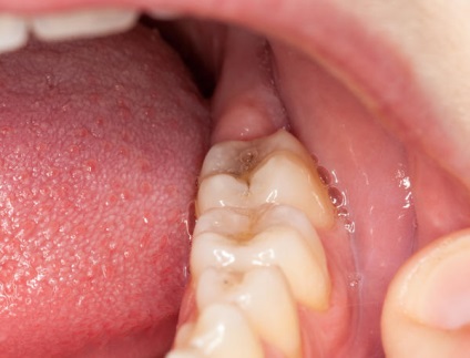 Durerea de dinți a cauzei și primul ajutor
