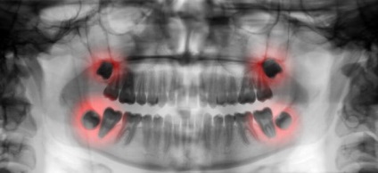 Durerea de dinți a cauzei și prim ajutor