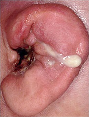 Abcesul cauzelor urechii externe, tratamentul, prognosticul