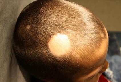 Alopecia la copii, tipuri, cauze, simptome și tratament
