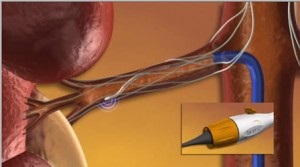 Astmul este asociat cu un risc crescut de atac de cord sau accident vascular cerebral