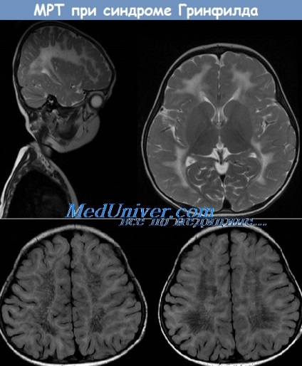 Ataxia în leucodistrofia metabolică - tablou clinic, diagnostic