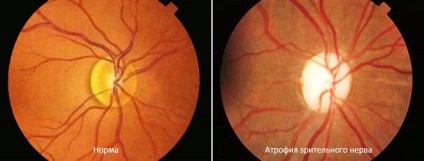 A látóideg tüneteinek, okainak és kezelésének atrófiája