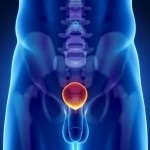Acenar adenocarcinom al prostatei, ce este?