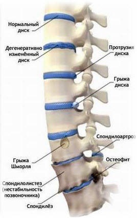 Fürdő osteochondrosis