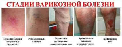 Durerea în picior sub genunchi în partea din spate a vițelului, decât vindeca ce să facă, simptomele