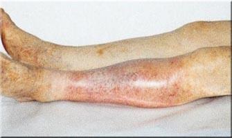 Durere la nivelul piciorului sub genunchi în partea din spate a vițelului, ce să tratăm, ce să facem, simptomele