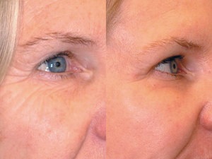 Evaluările botox privind efectele ridurilor netezite pe față și în jurul ochilor, prețul unei singure injecții de bothex