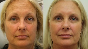 Evaluările botox privind efectele ridurilor netezite pe față și în jurul ochilor, prețul unei singure injecții de bothex