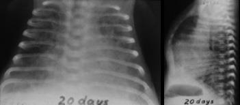 Displazie bronhopulmonară (blot), portal de radiologi