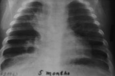 Displazie bronhopulmonară (blot), portal de radiologi