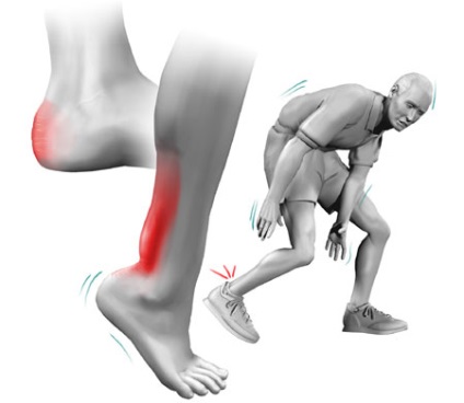 Bursita piciorului (glezna și altele), tratamentul, simptomele și cauzele