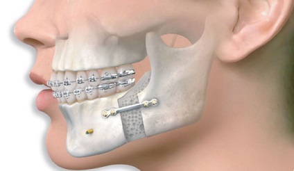 Operatie orala si maxilo-faciala - servicii si preturi de chirurgie maxilo-faciala