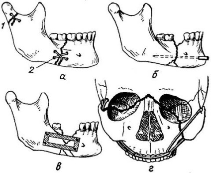 Operatie orala si maxilo-faciala - servicii si preturi de chirurgie maxilo-faciala