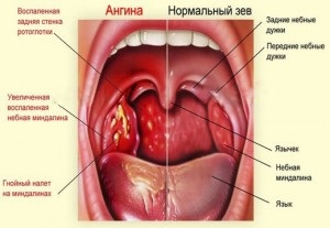 Mai mult decât atât, este posibil să se trateze o angina pectorală de tratament a anginei în condiții de casă