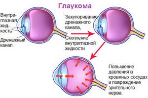 Care este glaucomul cauzei apariției sale, principalele simptome și tratament