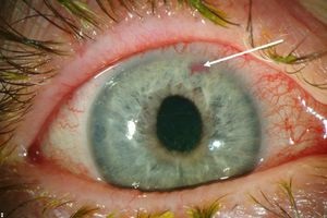 Care este glaucomul cauzei apariției sale, principalele simptome și tratament