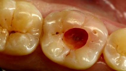 Ce este umplerea dinților?