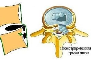 Care este ruptura herniului intervertebral și cât de periculoasă este aceasta?