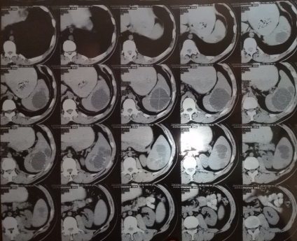 Diagnosticul diferențial al echinococcozei splinei