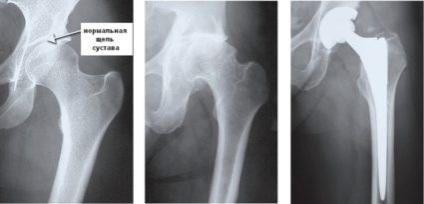 Endoprotetice ale reabilitării articulațiilor șoldului după intervenție chirurgicală