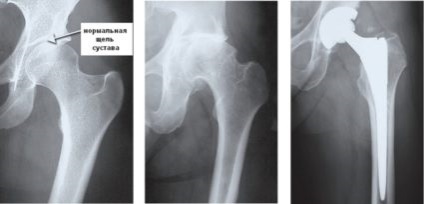 Hip arthroplasty műtétek utáni rehabilitációra