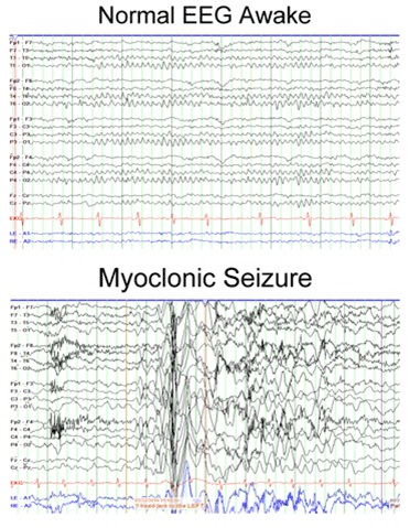 Epilepszia, kezelési eljárásokat valproát és szerepét a betegség kezelésére