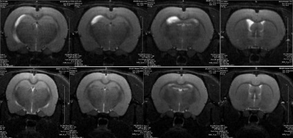 Epilepsia, metodele de tratament și rolul acidului valproic în terapia bolii