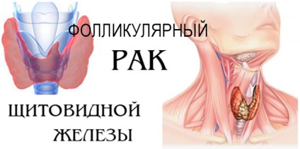 Фолікулярний рак щитовидної залози прогноз після операції, у кого є шанси