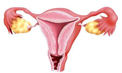 Sângerare hipotonică în perioada postpartum timpuriu
