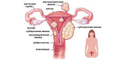 Hirudoterapia cu miom uterin