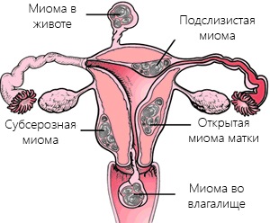 Hirudoterapia cu miom uterin